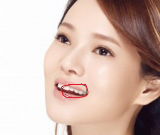 矫正牙齿什么样的虎牙能拔、矫正牙齿什么样的虎牙能拔下来(图1)